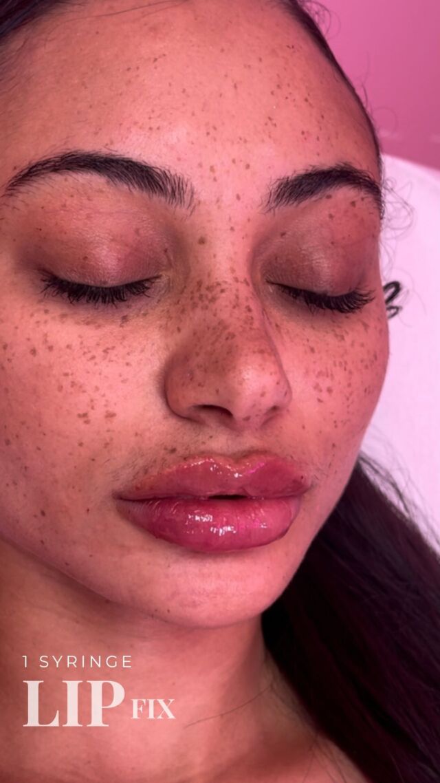 Hush L.A. Medspa - 🧵 Lifting the tip of the nose can make the